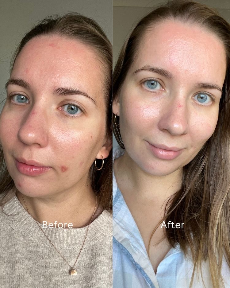 Before and after comparison of a woman&