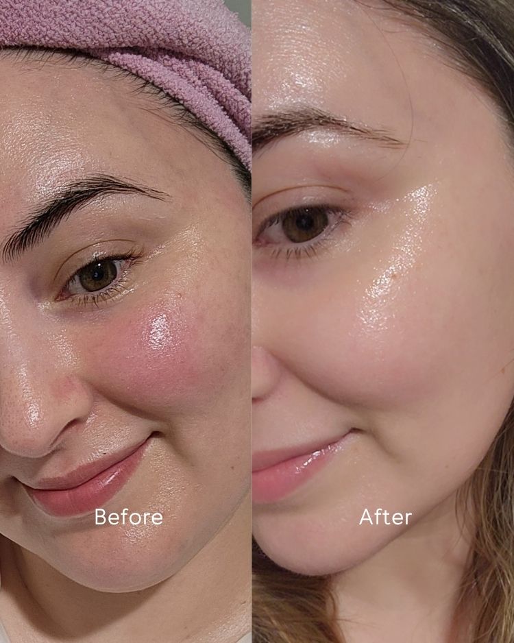 Before and after comparison of a woman&