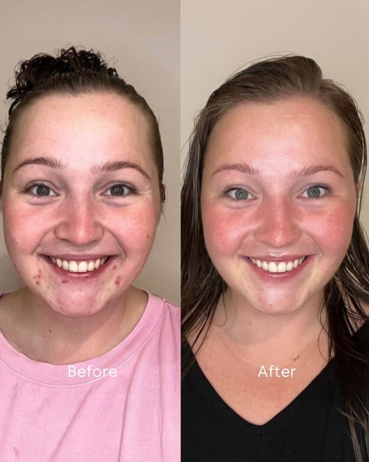 Before and after comparison of a person with acne on their face.