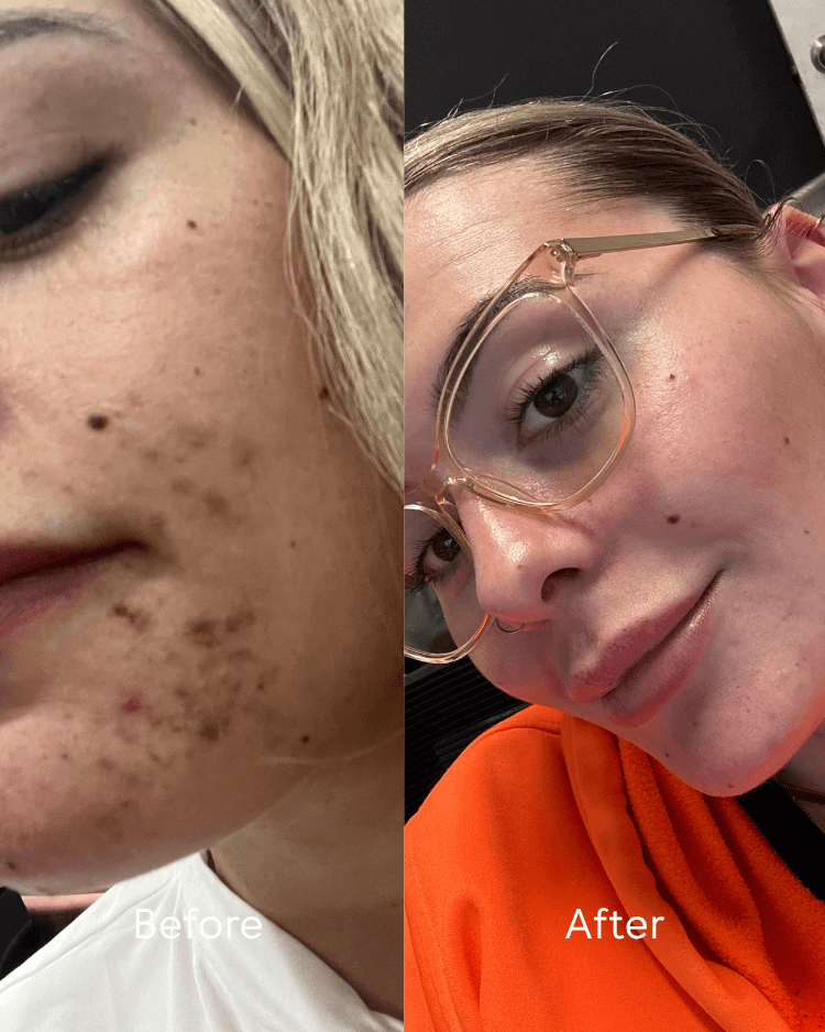 Before and after comparison of a person with visible skin transformation using the best hydrating serum for dry sensitive skin.