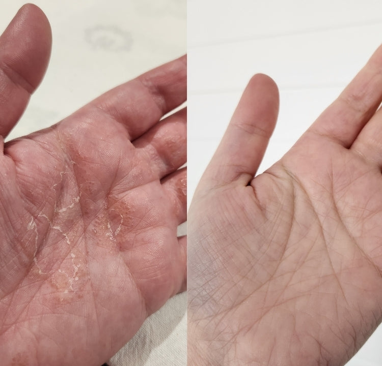 Before and after comparison of a hand with visible skin conditions on a plain background