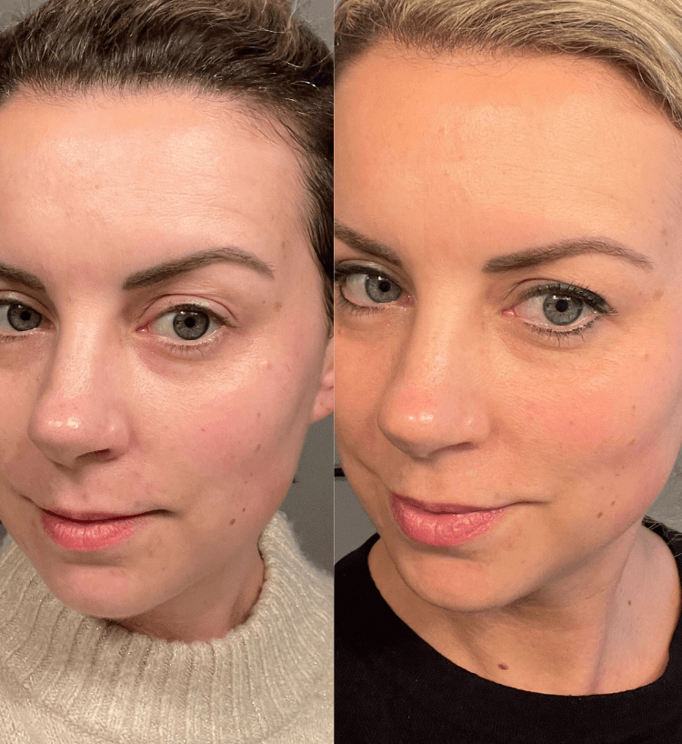 Before and after comparison of a woman&