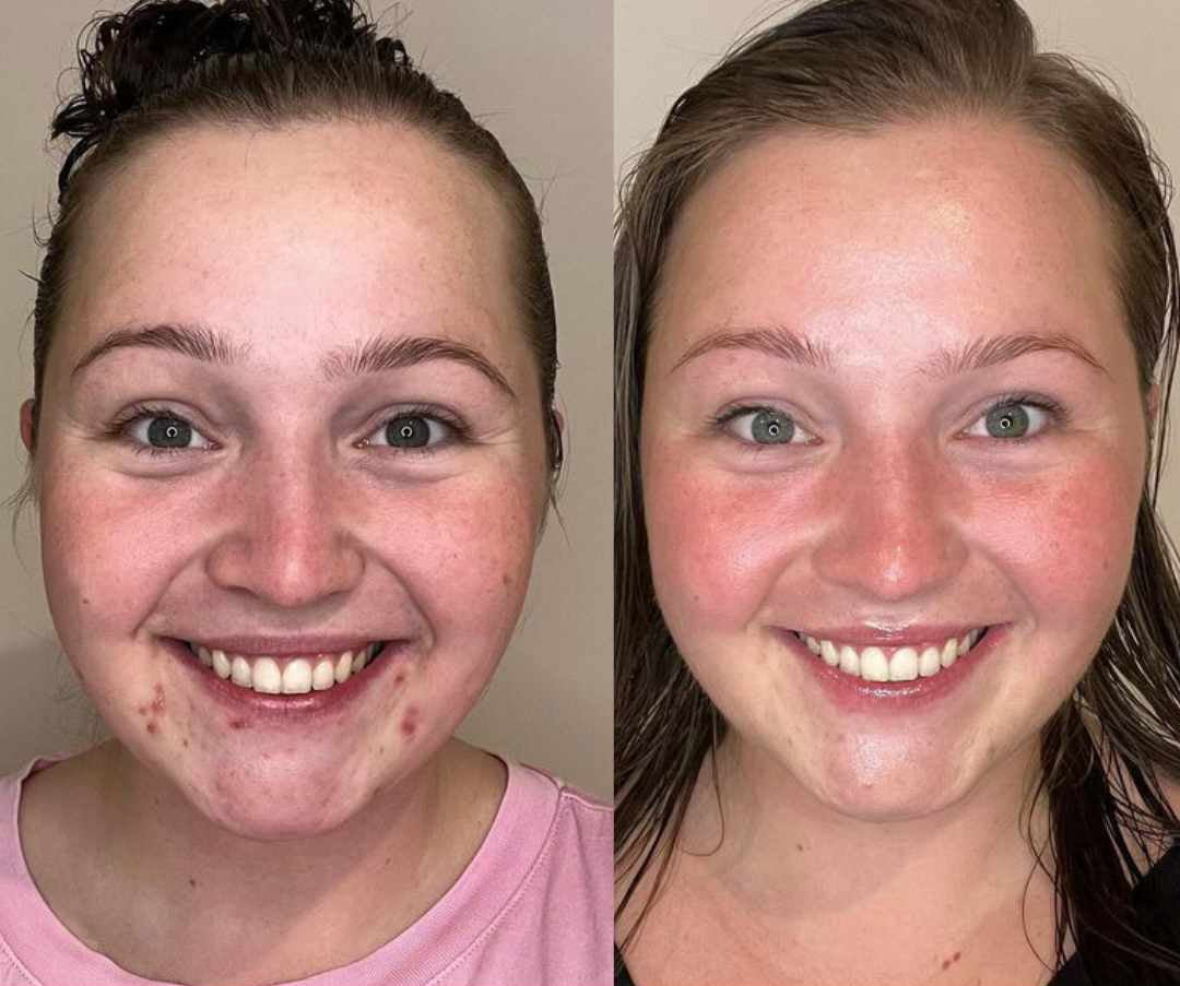 sensitive skin products before and after