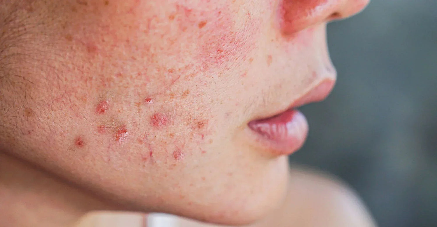 Acne rosacea vs acne vulgaris