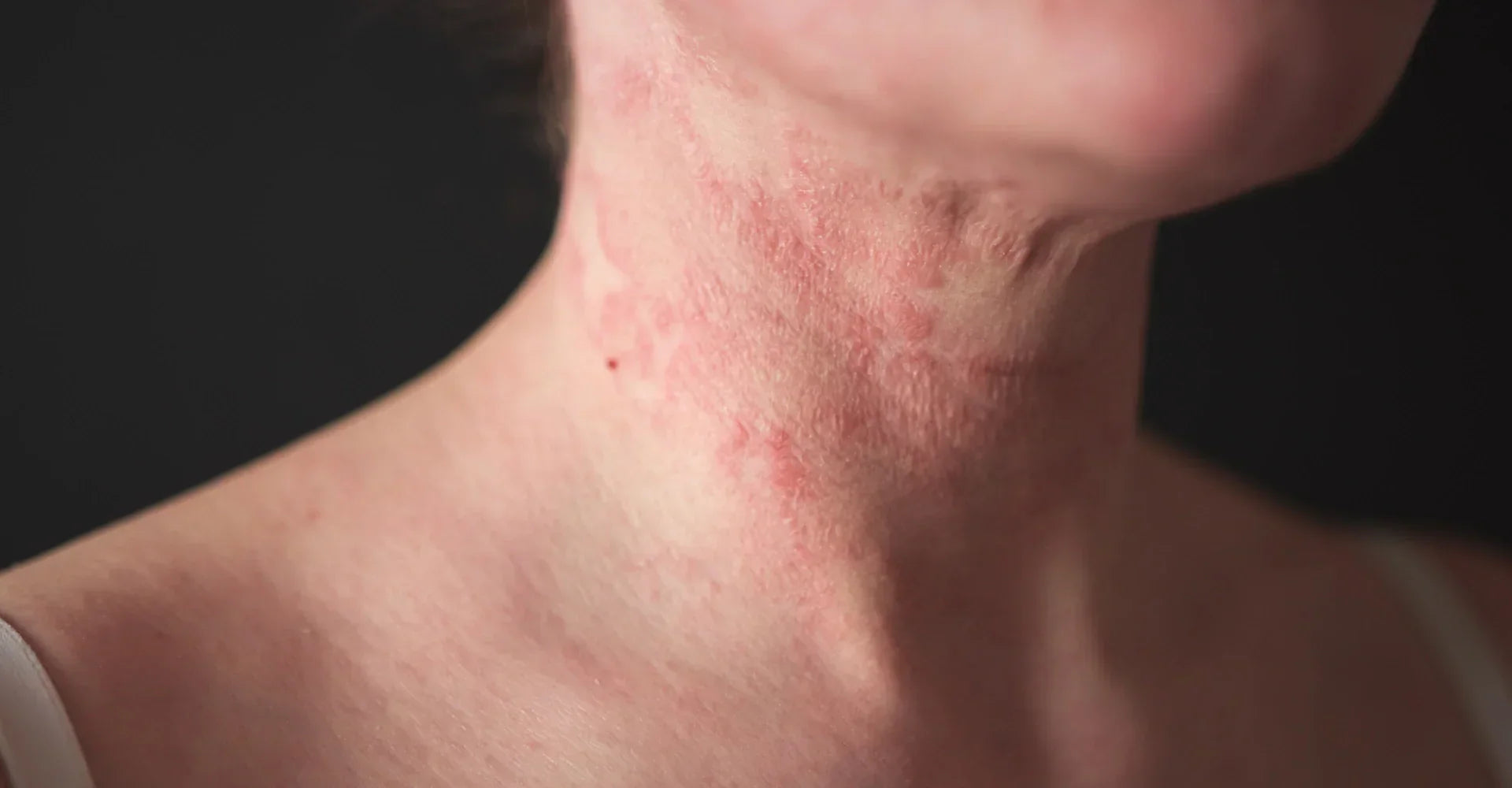 Can colloidal oatmeal help eczema-prone skin