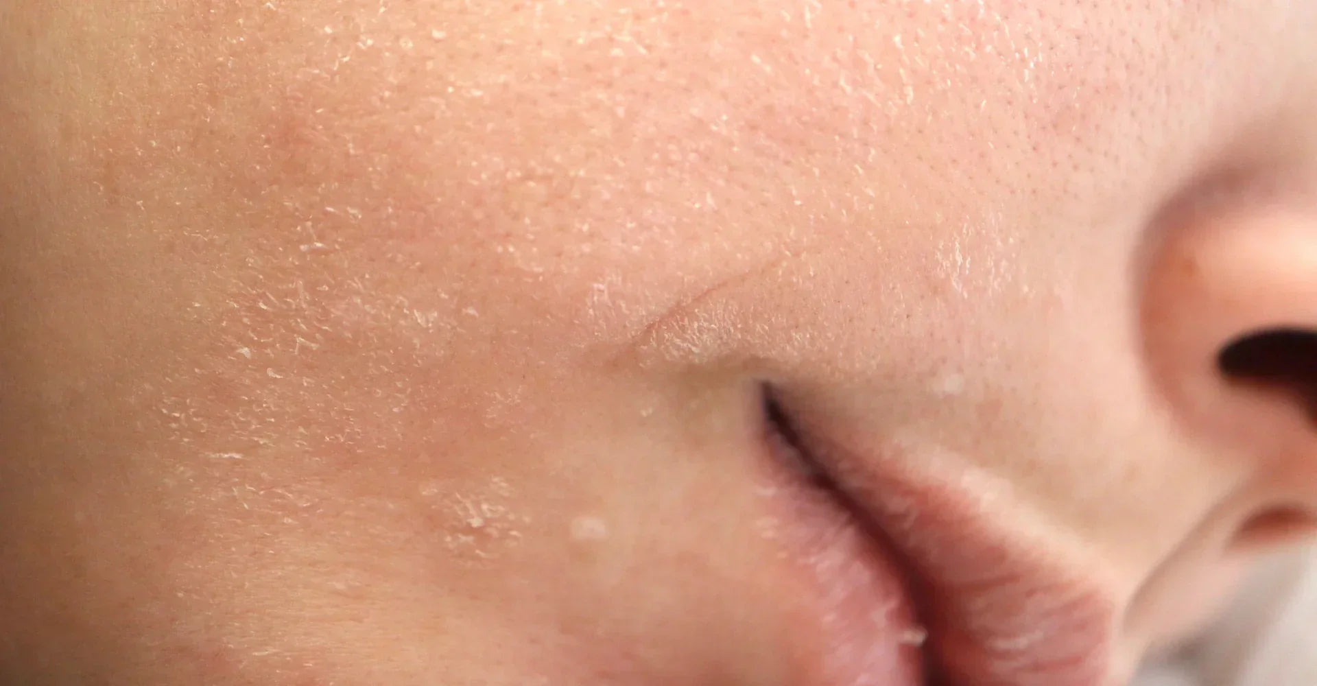 Dry Patches on Face How to Get Rid Of