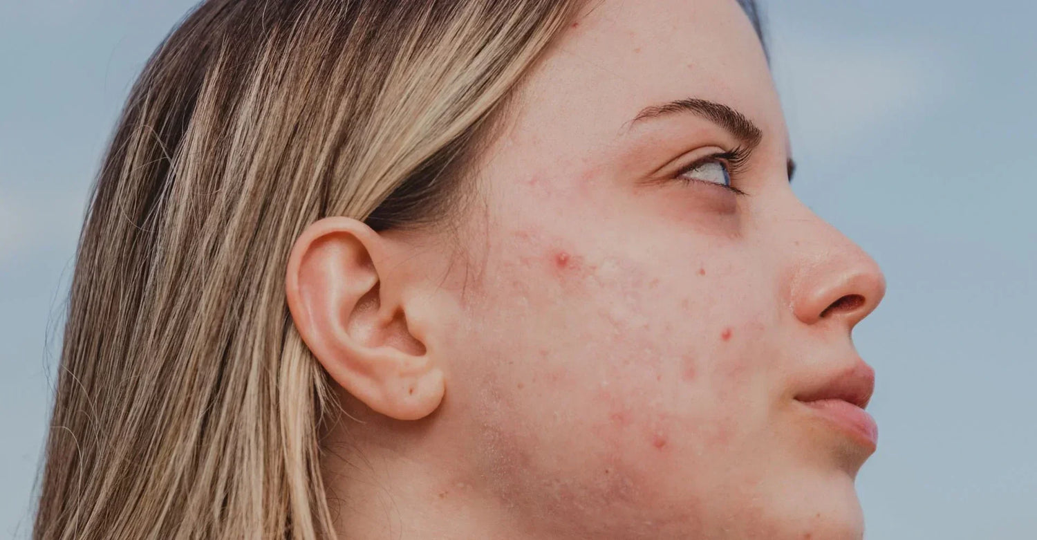 7 Hyaluronic Acid Benefits for Acne and Breakout Prone Skin