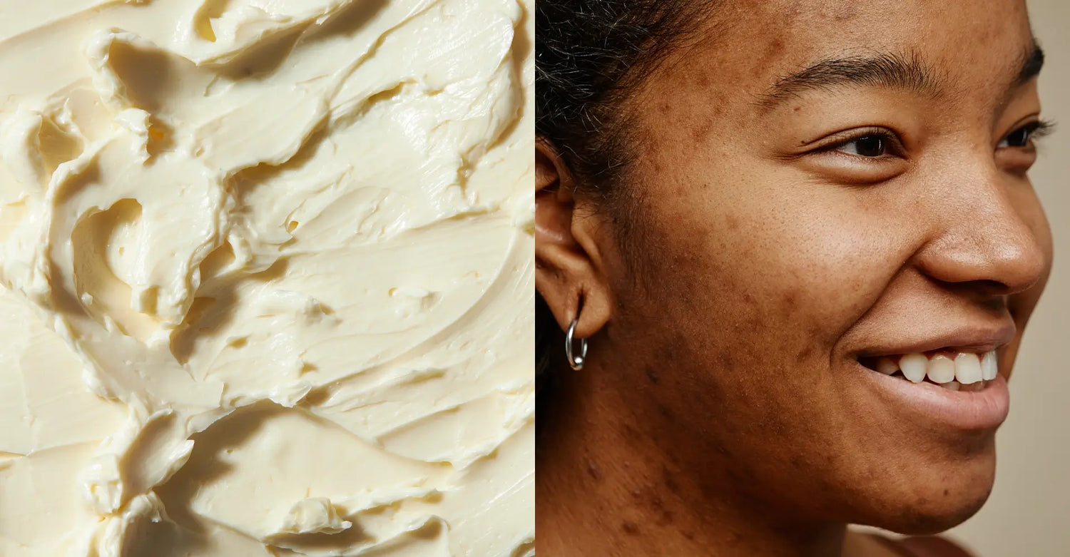 Shea butter for acne