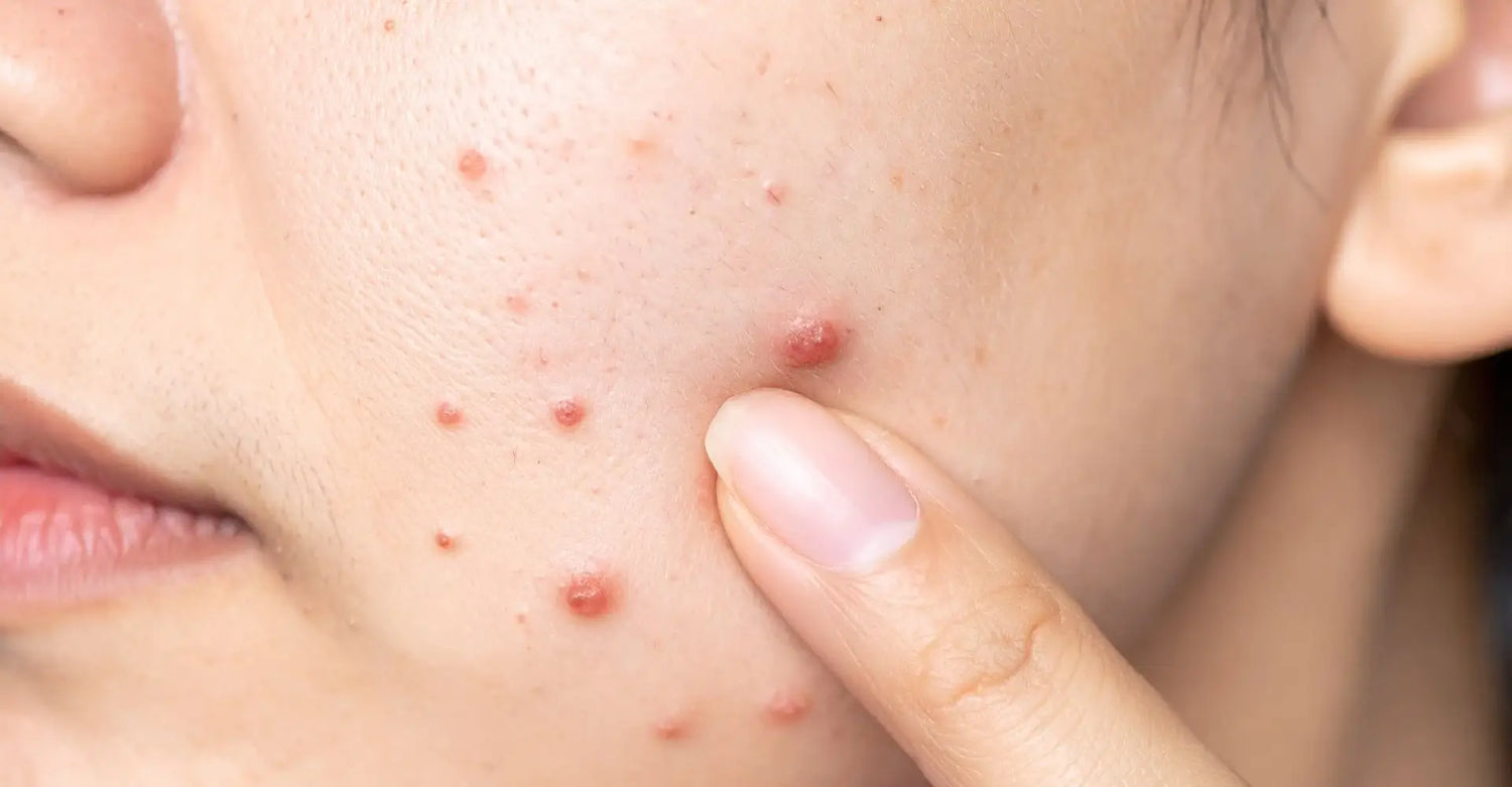 When does adult acne stop