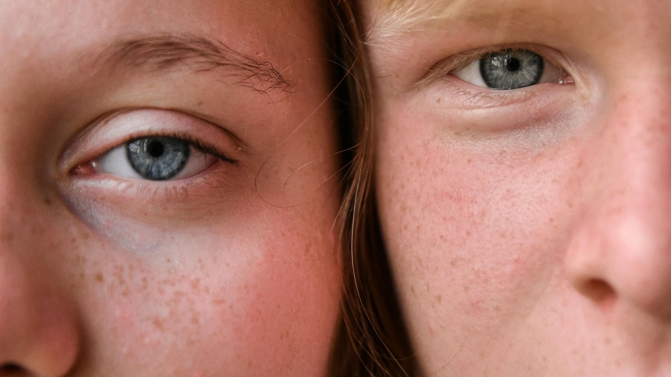 skin redness blog article