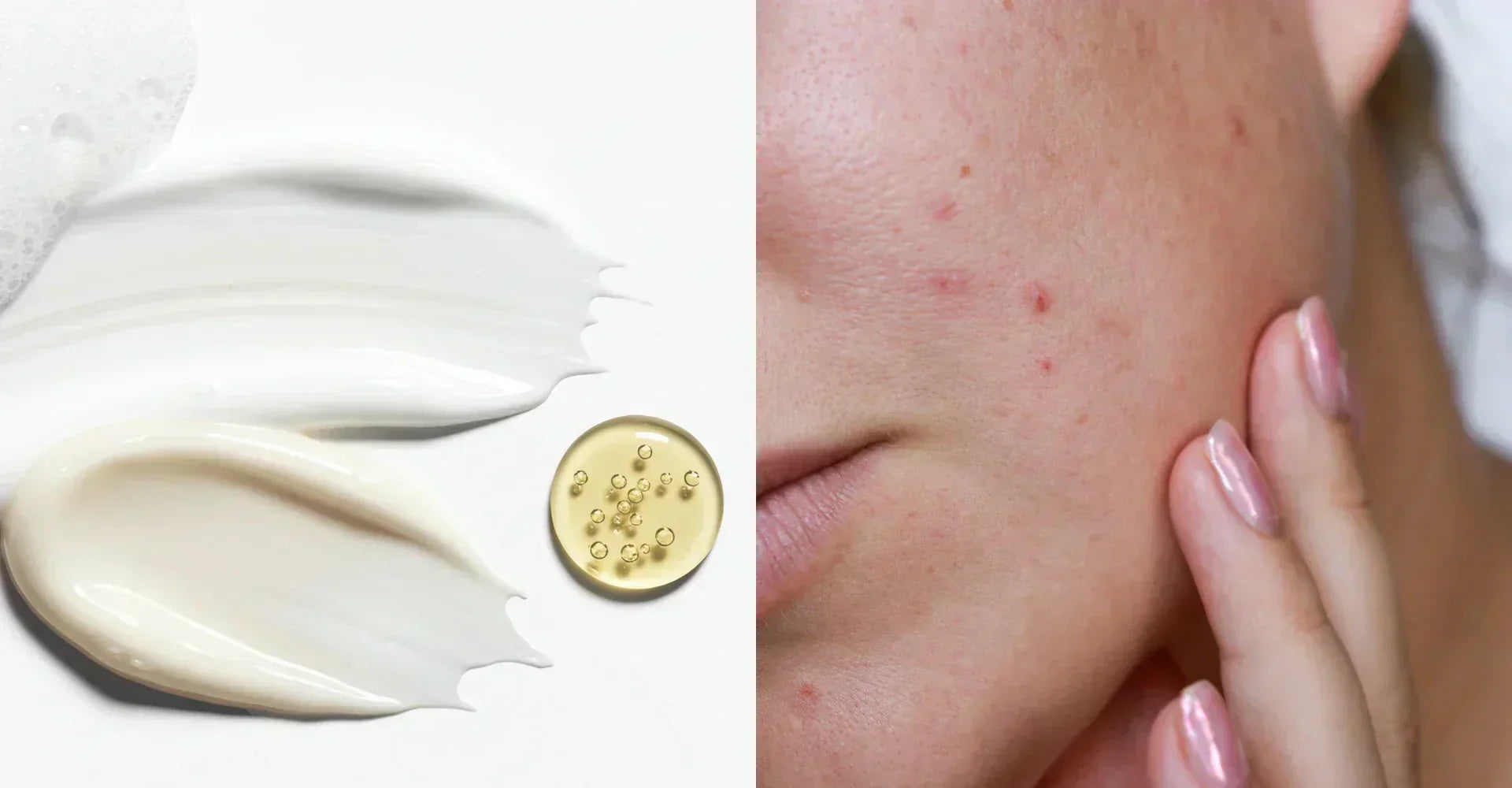  acne prone skin products 