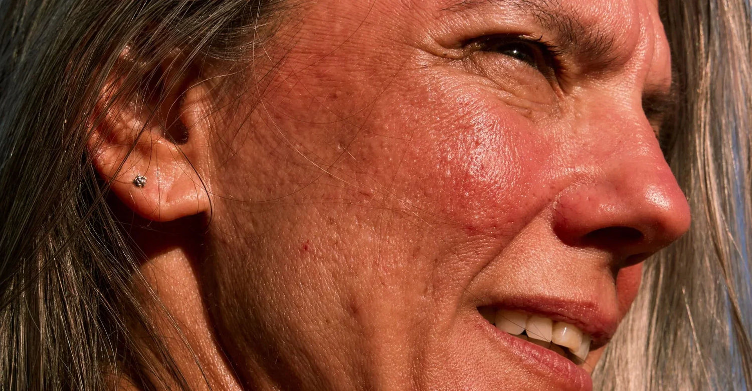 How to Calm a Summer Flare-Up on Sensitive Skin