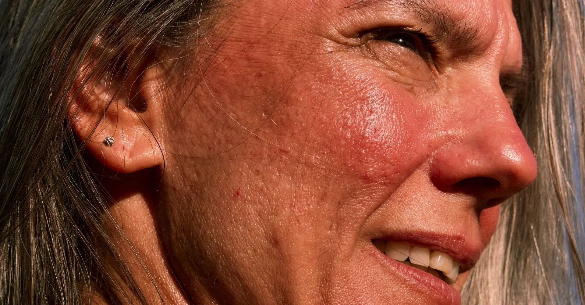 How to Calm a Summer Flare-Up on Sensitive Skin