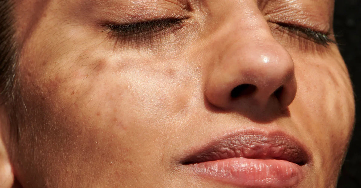 Menopause and Pigmentation: Dark Spots and Uneven Tone Explained