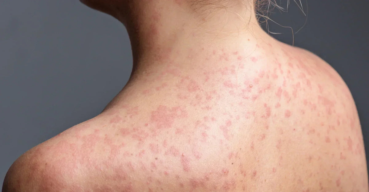Preventing Heat Rash on Sensitive Skin