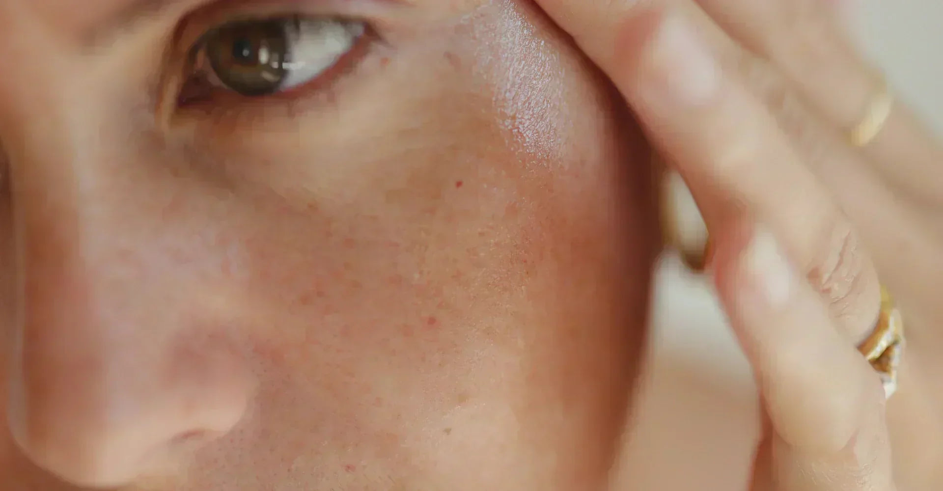 rosacea skincare routine for beginners