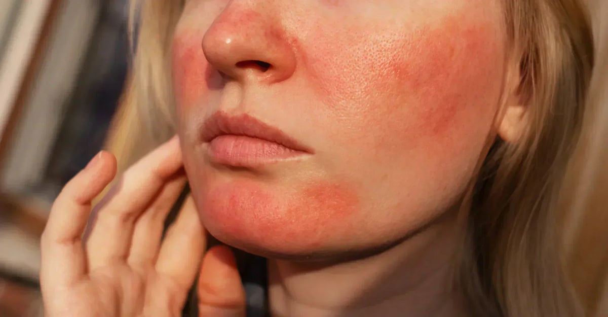 what triggers rosacea