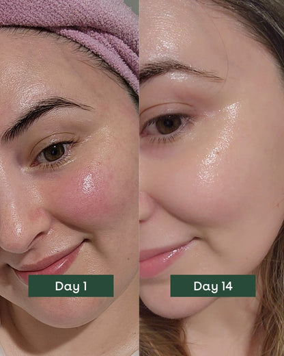 Hydration Serum for Rosacea