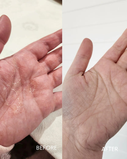 Before and after comparison of a hand with visible skin conditions on a plain background